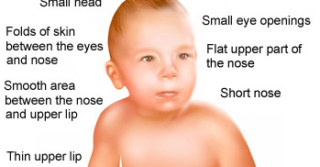 Fetal alcohol syndrome ‘unacceptably high’