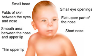 Fetal alcohol syndrome ‘unacceptably high’